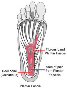 Plantar Fasciitis Explanation