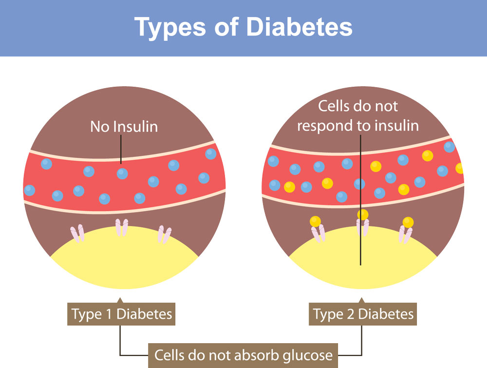 Differences between Type 1 and type 2 Diabetes