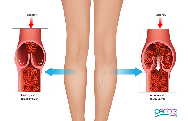 Venous Insufficiency Disease Illustration